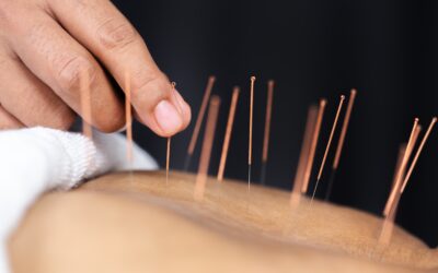 Is Acupuncture Safe for Car Accident Injury Recovery?